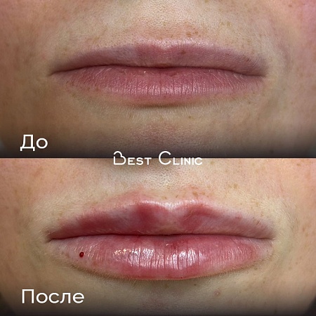 Контурная пластика губ (Belotero Lips Contour)