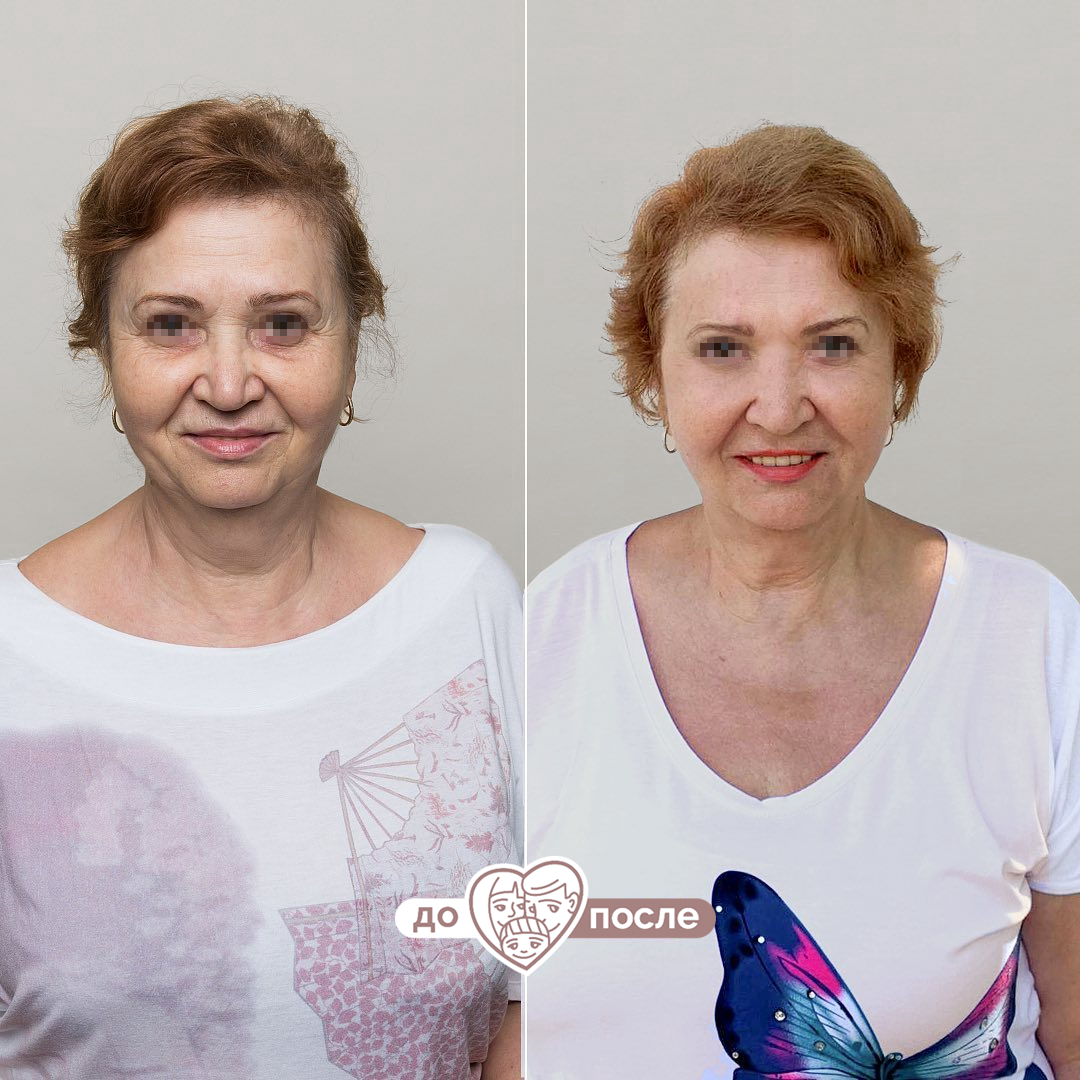 SMAS-лифтинг Doublo HiFu