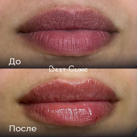 Контурная пластика губ (Belotero Lips Contour)