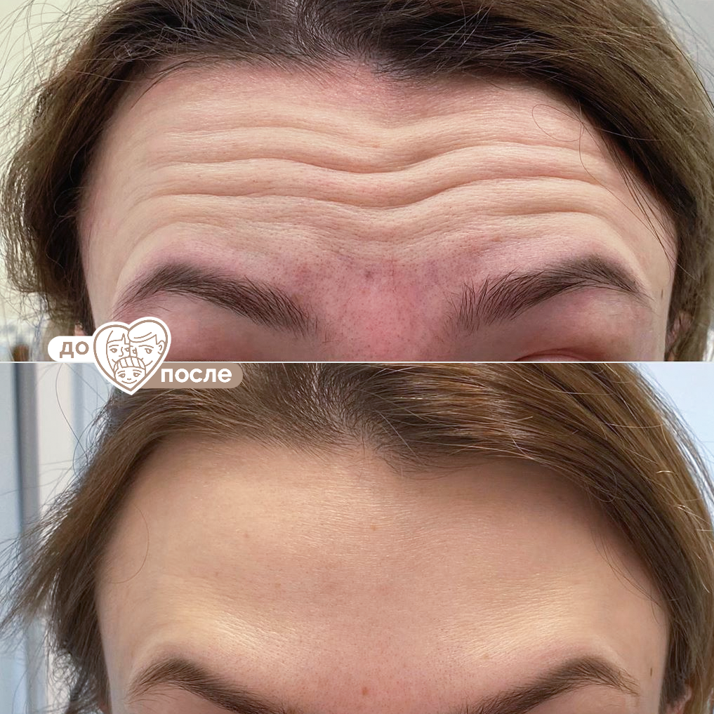 Ботулинотерапия
