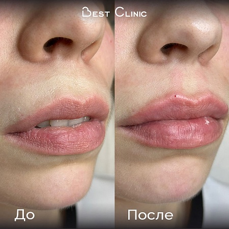 Контурная пластика губ (Belotero Lips Contour)